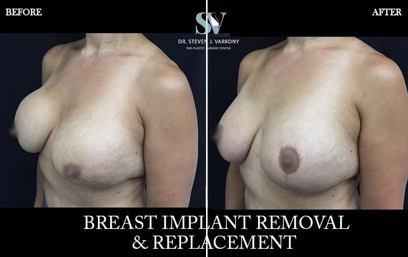 Breast Revision and implant Removal