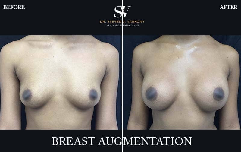 Breast augmentation encino before and after front