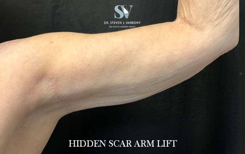 Hidden Scar Arm Lift