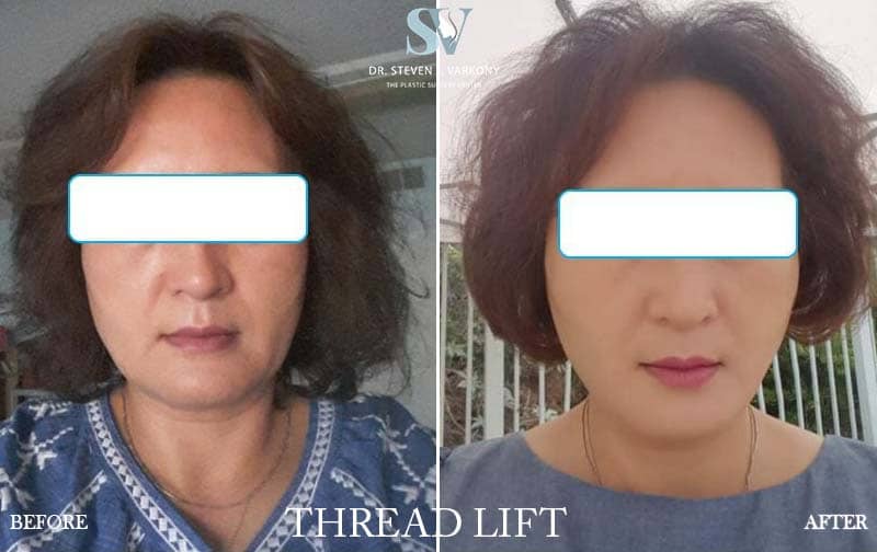 Threadlift before and after