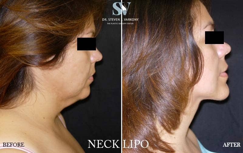 neck lipo before and after
