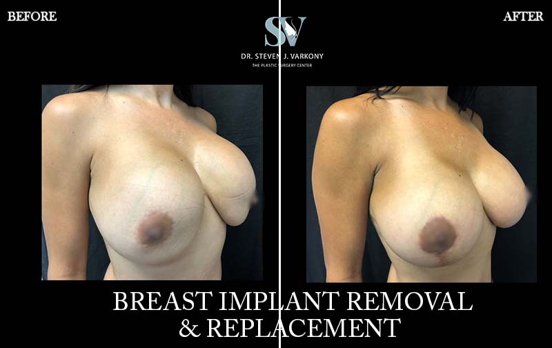Breast Revision and implant Removal