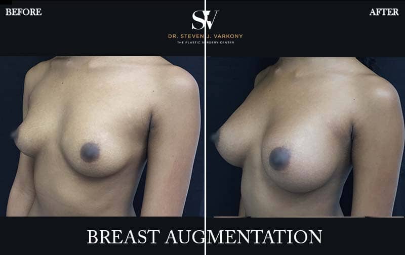 Breast augmentation encino before and after side