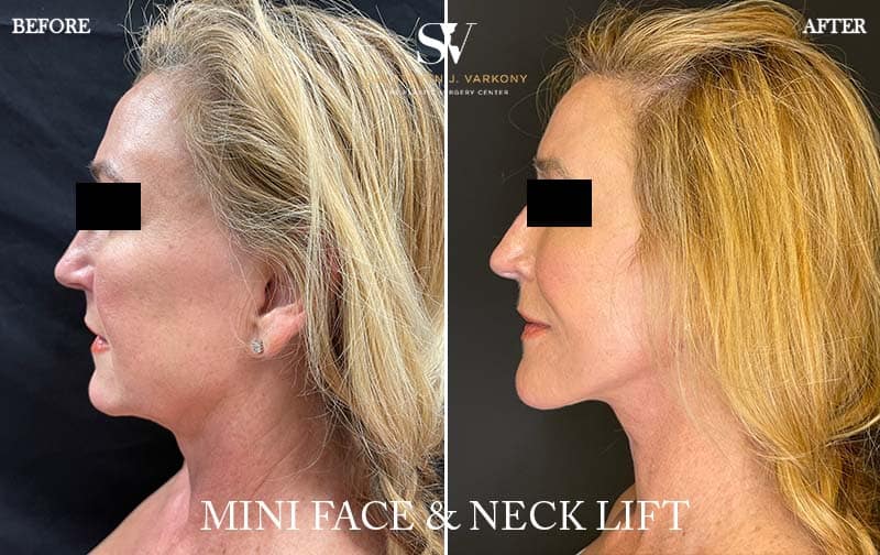 mini face and neck lift before and after result