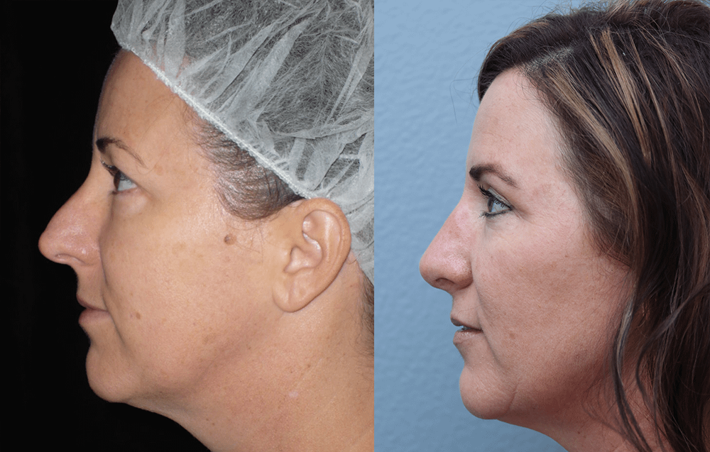 Rhinoplasty Before & After Photos Left Side