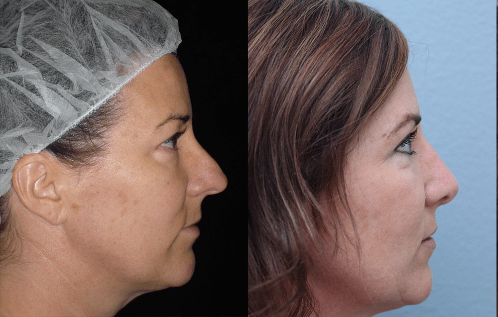 Rhinoplasty Before & After Photos Right Side