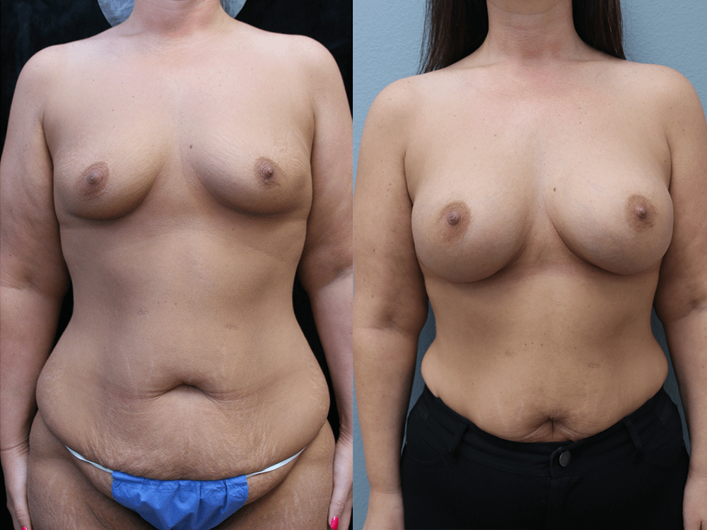Breast Augmentation with Asymmetry Before & After Photos