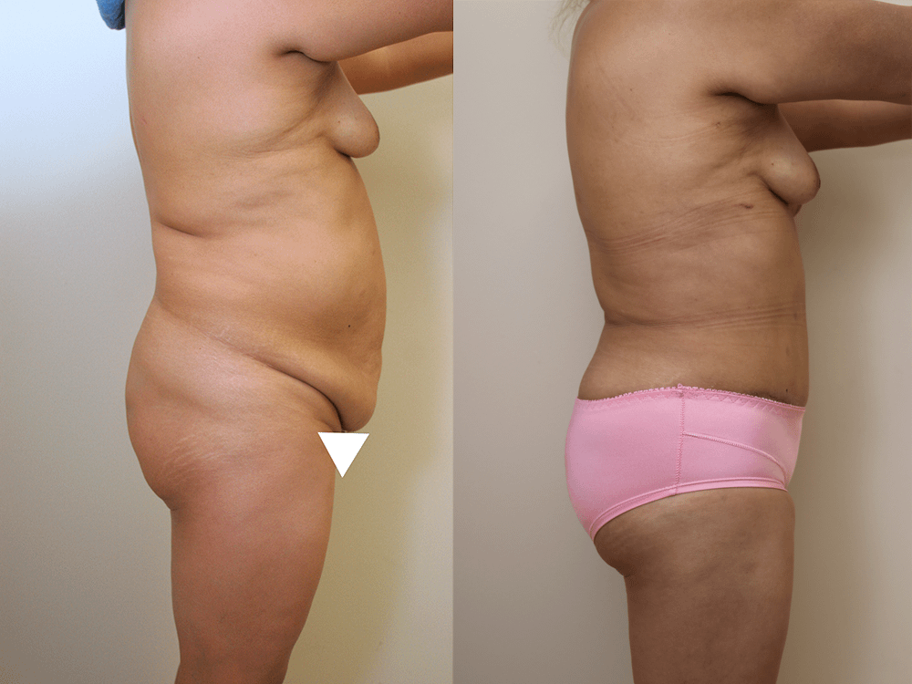 Tummy Tuck Before & After Photos Right Side