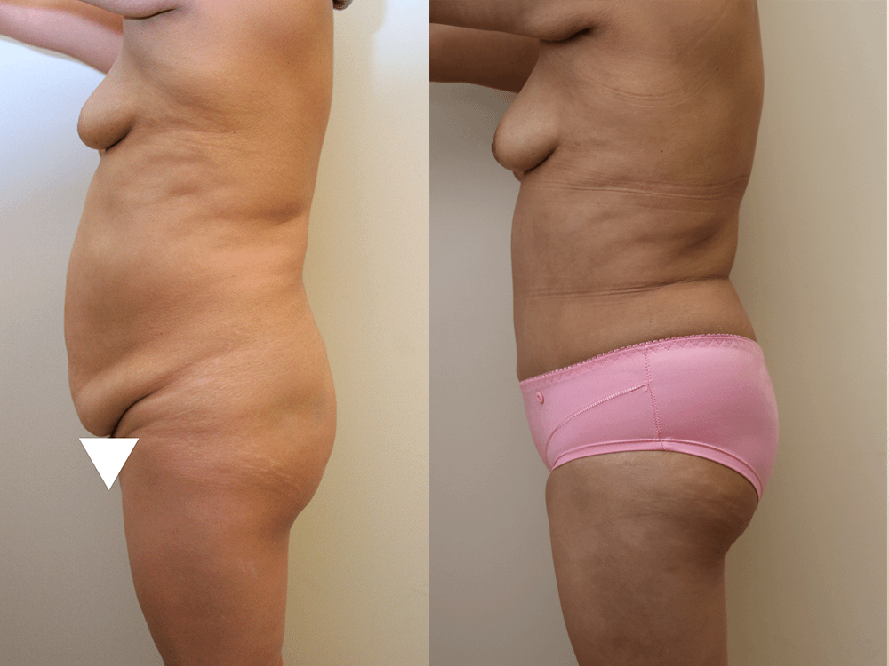 Tummy Tuck Before & After Photos Left Side