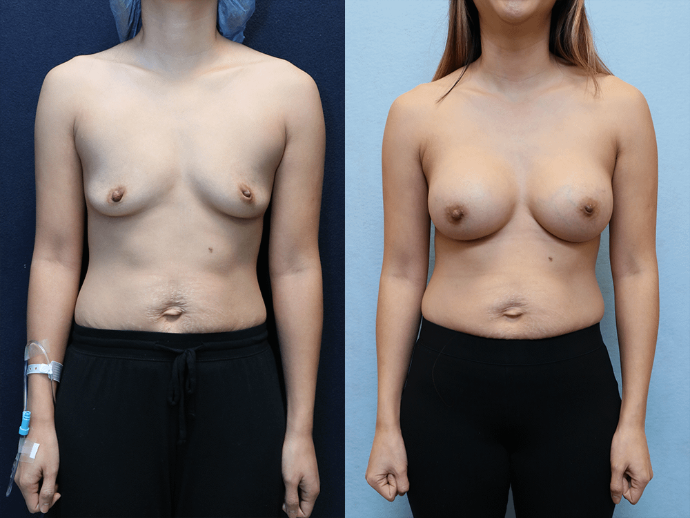 Breast Augmentation with Asymmetry before and after photos front