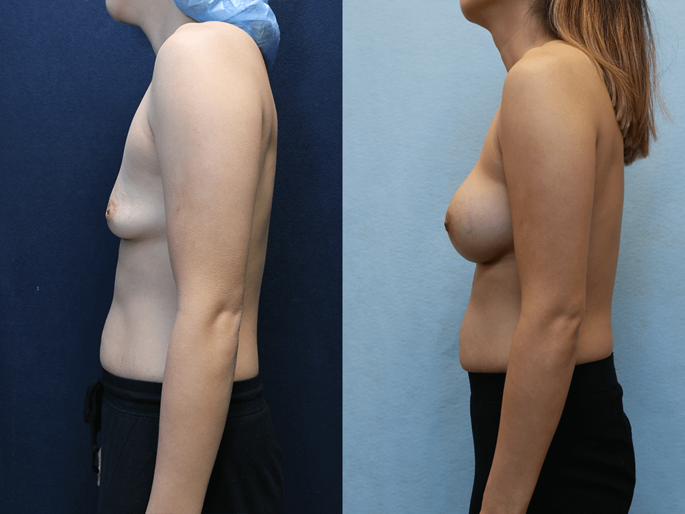 Breast Augmentation with Asymmetry before and after photos left