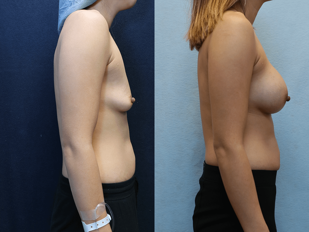 Breast Augmentation with Asymmetry before and after photos right