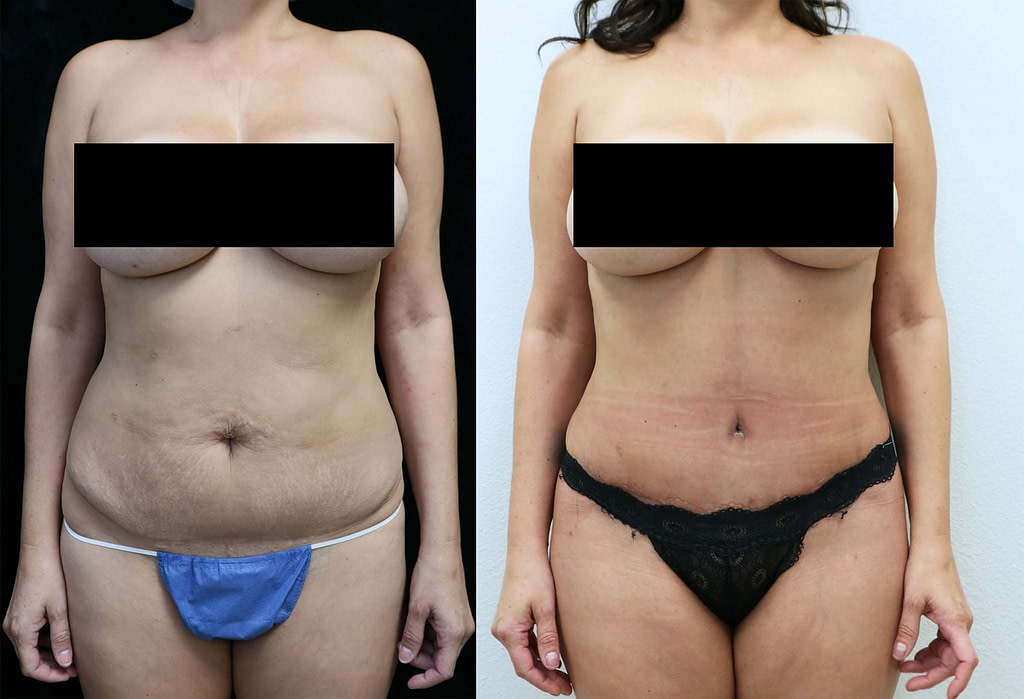 abdominoplasty before and after photos