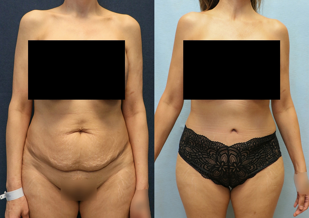 tummy tuck orange county before and after