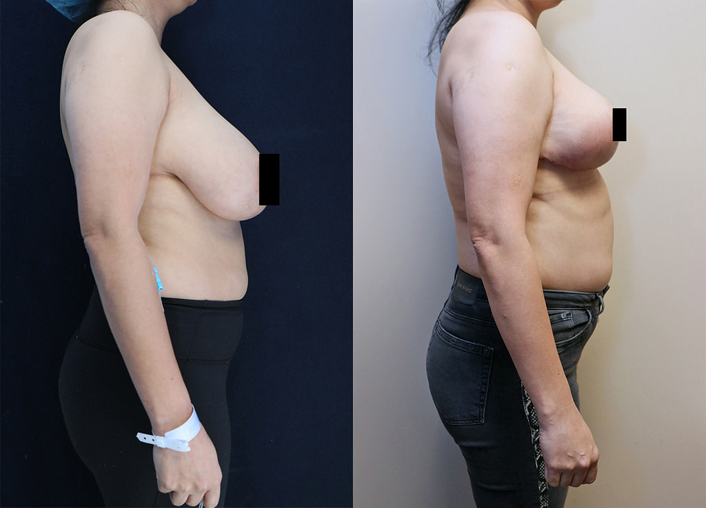 bilateral breast reduction before and after right