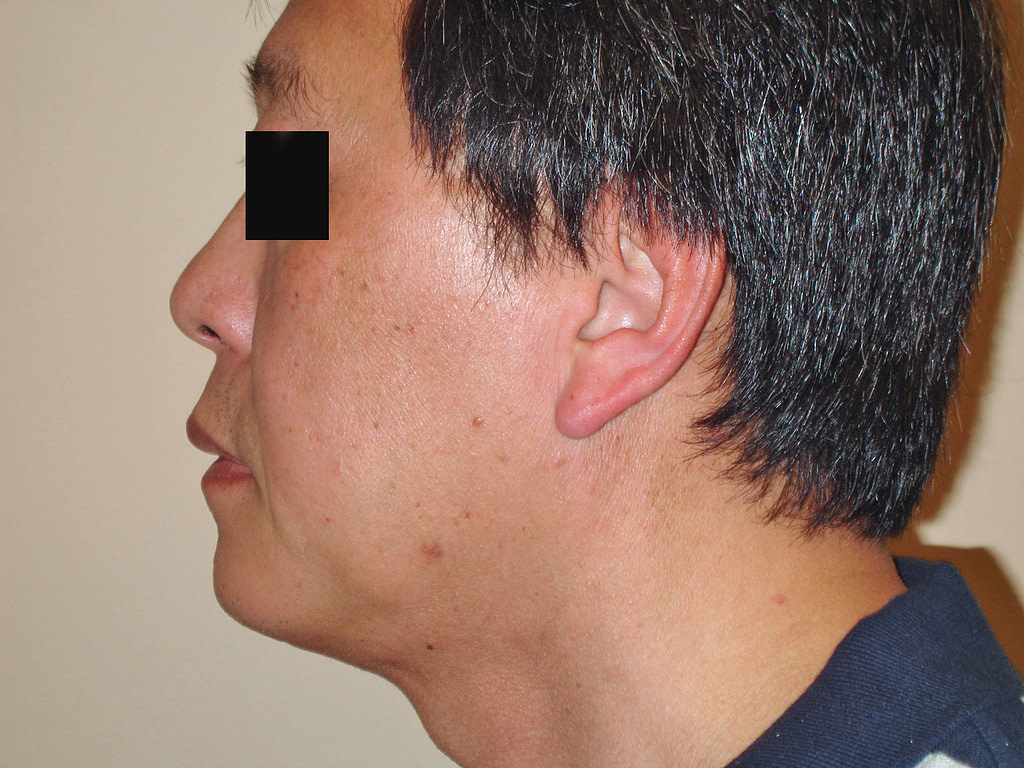 Chin Augmentation for Men Before & After Photos