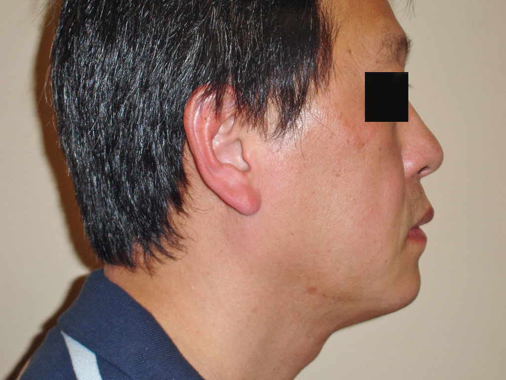 Chin Augmentation for Men Before & After Photos