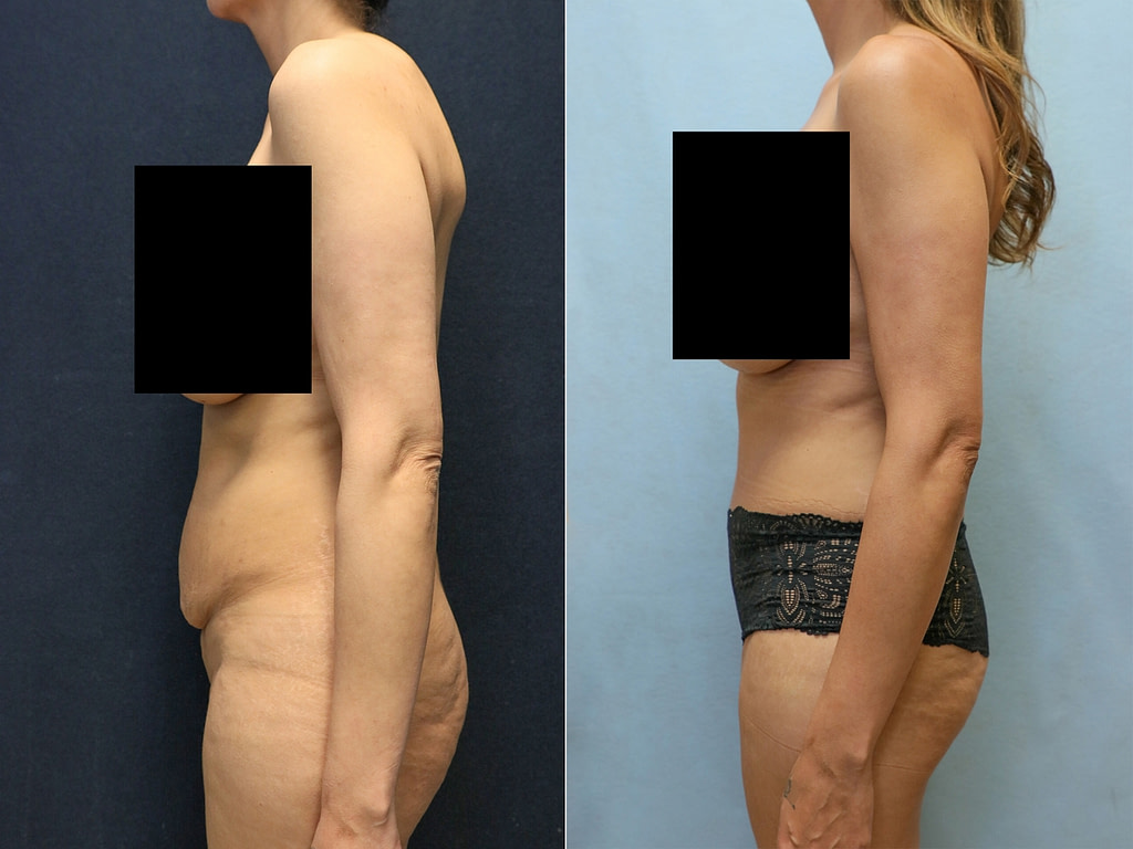 tummy tuck in orange county before and after