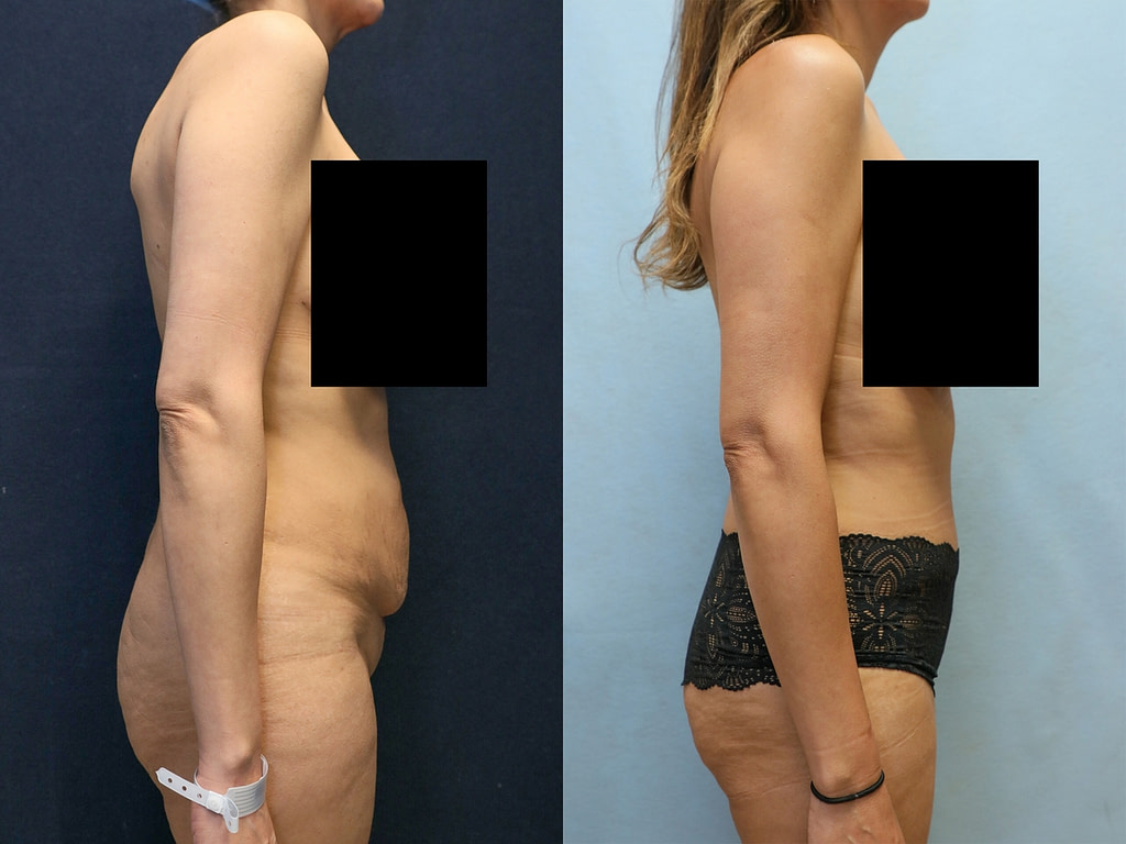 tummy tuck in orange county before and after