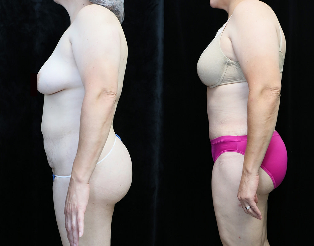 tummy tuck in orange county CA before and after photos