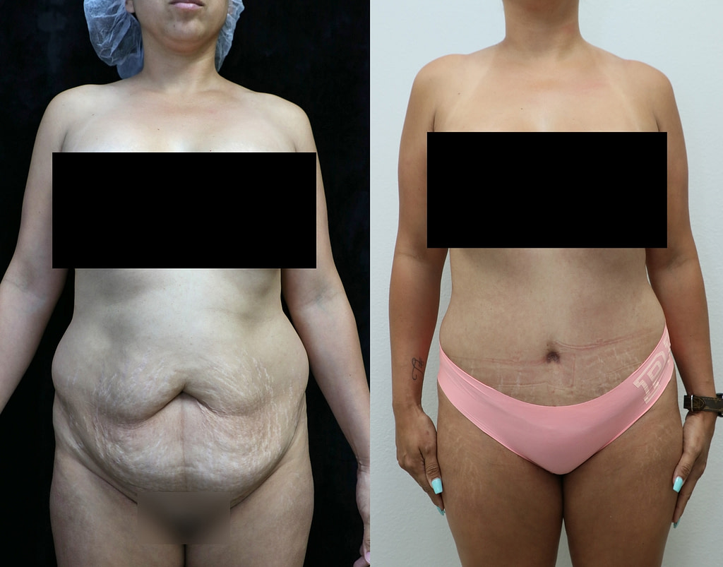 tummy tuck orange county before and after photos front