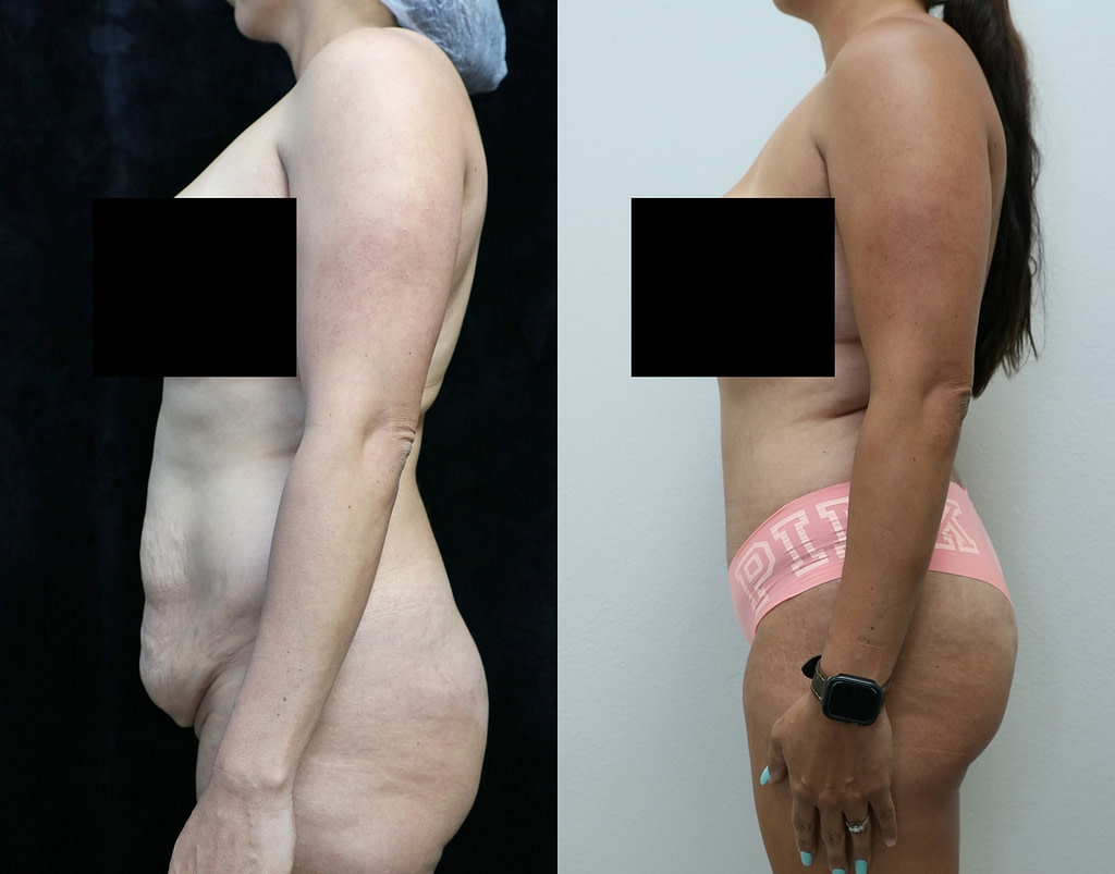 tummy tuck orange county before and after photos left