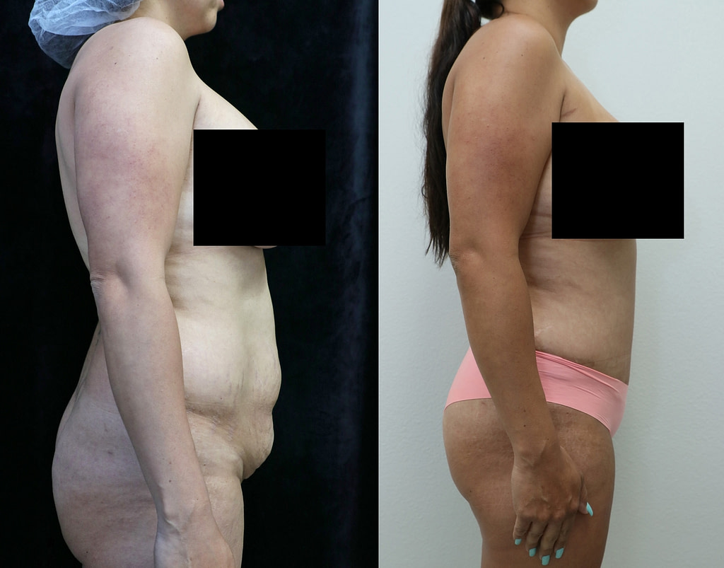 tummy tuck orange county before and after photos right