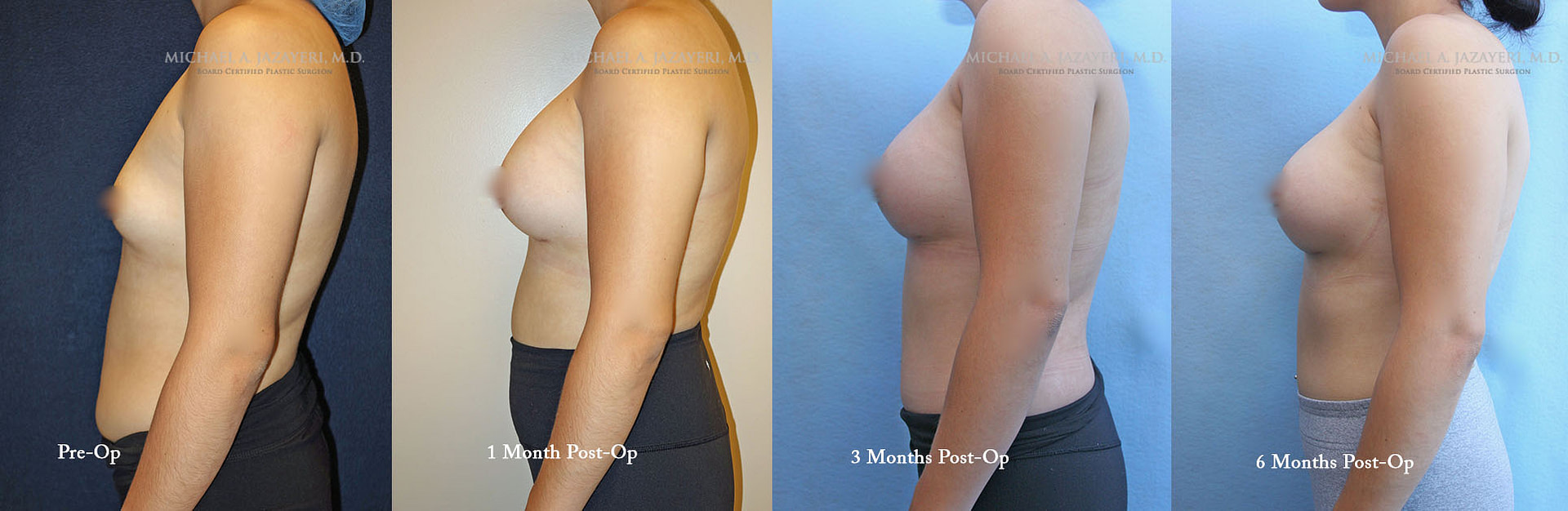 BREAST AUGMENTATION RECOVERY MONTH TO MONTH left side