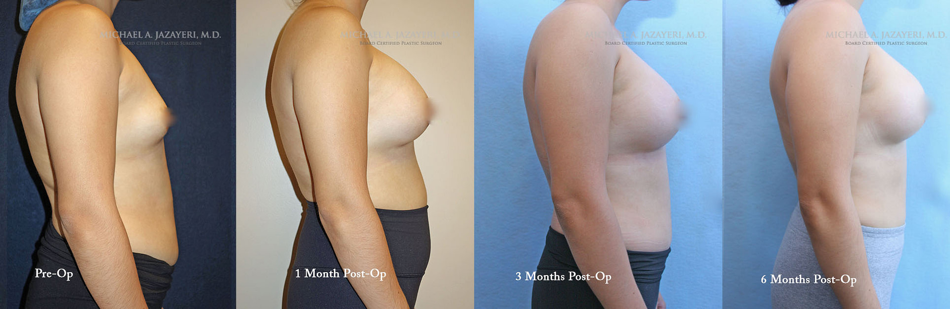 BREAST AUGMENTATION RECOVERY MONTH TO MONTH right side