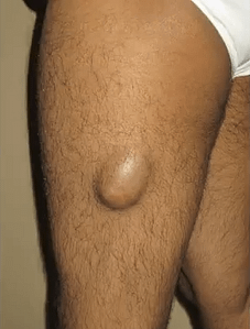 skin tumor or cyst