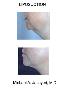 liposuction neck