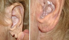 torn or streched earlobe repair surgery