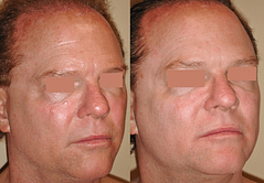Facial skin rejuvenation with Mixto Laser