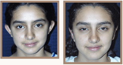 before-and-after-otoplasty