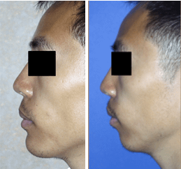 before-and-after-rhinoplasty