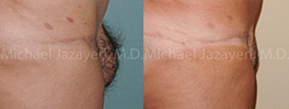 Pubic Lift Before & After Photos