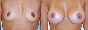 Orange County Breast Implants Before and after surgery