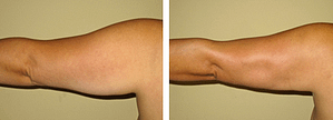 Before and After Arm Liposuction Photos Peformed by Dr. Jaz