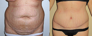 Tummy Tuck surgery before and after