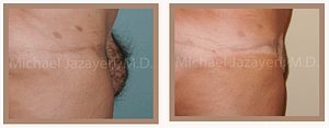 Pubic Liposuction and Lift - FUPA