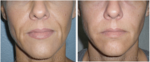 Before and After Injectable Filler