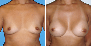 Breast Augmentation Before and After Pictures, Orange County
