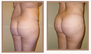 butt augmentation using fat transfer