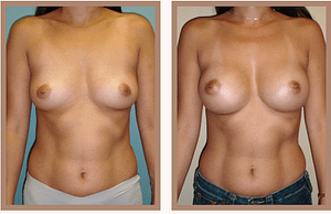Breast Implant Shape