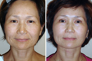 MIXTO LASER RESURFACING before after