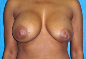 breast implant complications