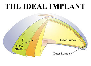 The IDEAL Implant