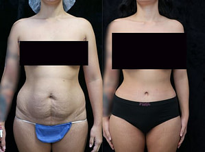 front before and after photos tummy tuck