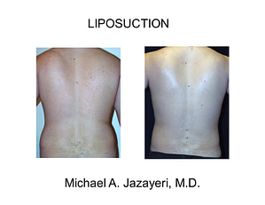 liposuction back