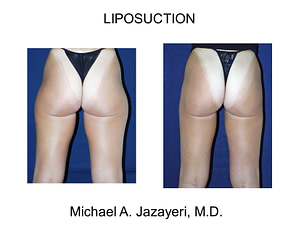 liposuction legs